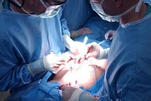 Running operations to improve penis