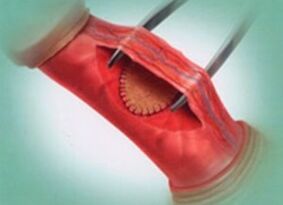 Surgical means to improve members
