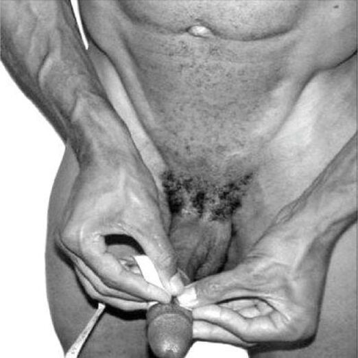 Measurement of the penis before enlargement